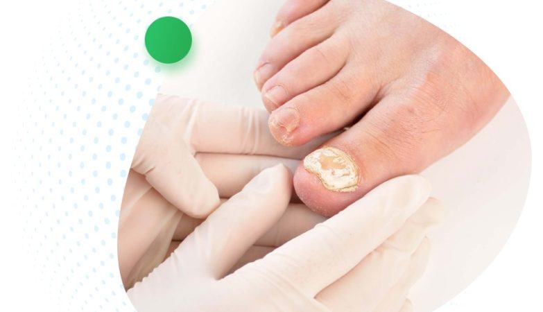 Home Remedies To Get Rid Of Toenail Fungus Infection